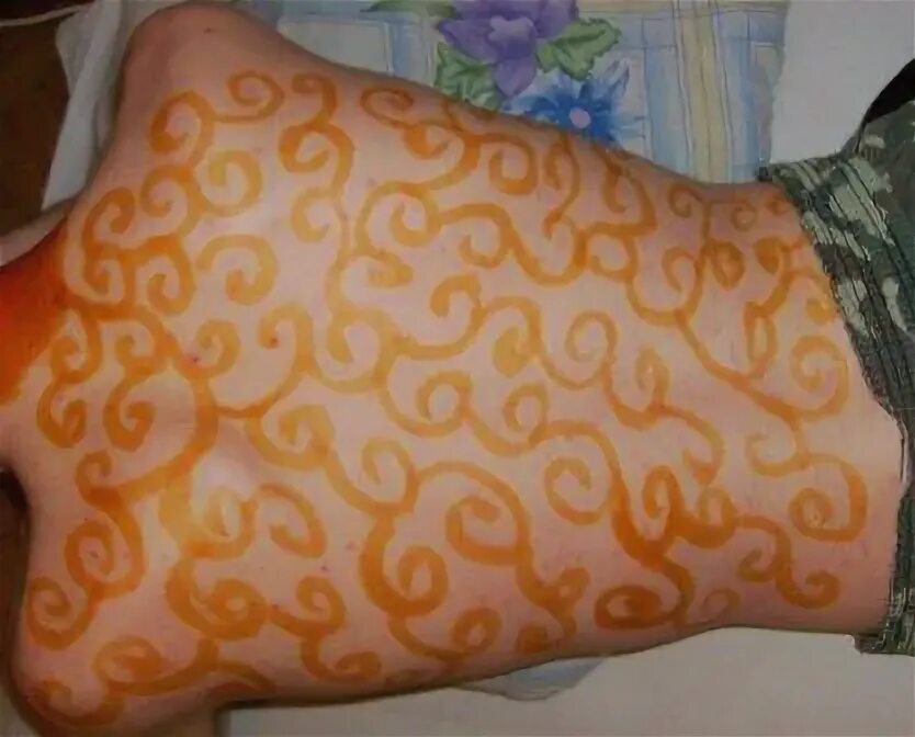 Сетка уколов. Йодовая сеточка на руке. Йодовая сетка после уколов на ягодицах. Йодовая клетка при кашле. Сетка уколов.