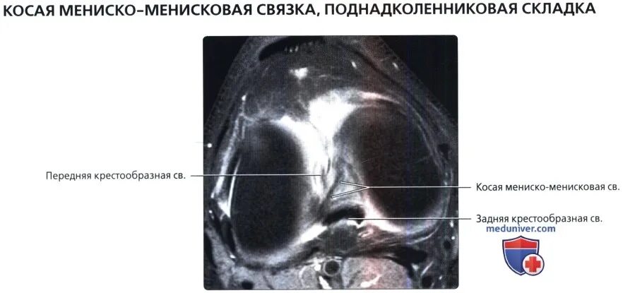 Дегенеративные изменения крестообразных связок коленного сустава. Анатомия менисков коленного сустава мрт. Задняя мениско бедренная связка мрт. Межменисковая связка мрт.