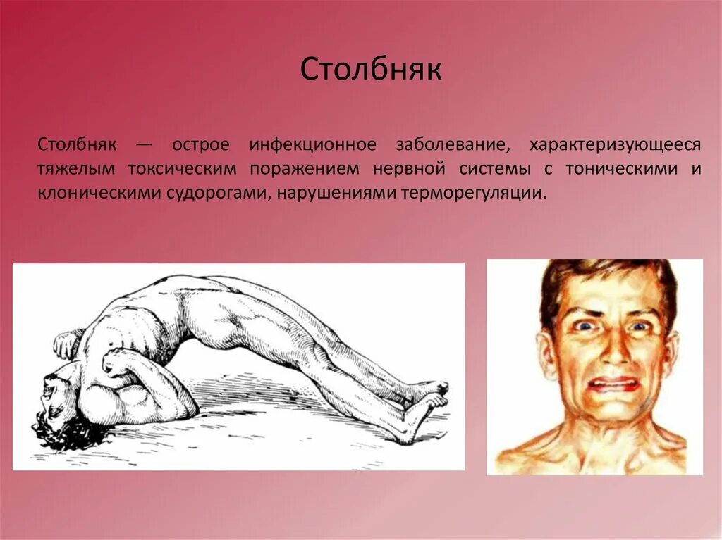 Тризм жевательных мышц. Тризм жевательных мышц столбняк. симптомы столбняка опистотонус. столбняк характерные клинические проявления.