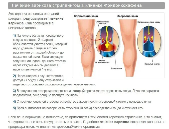 Варикозное расширение вен нижних конечностей клиника. Схема лечения варикоза. Профилактика варикоза схема. Современный способ лечения варикоза.