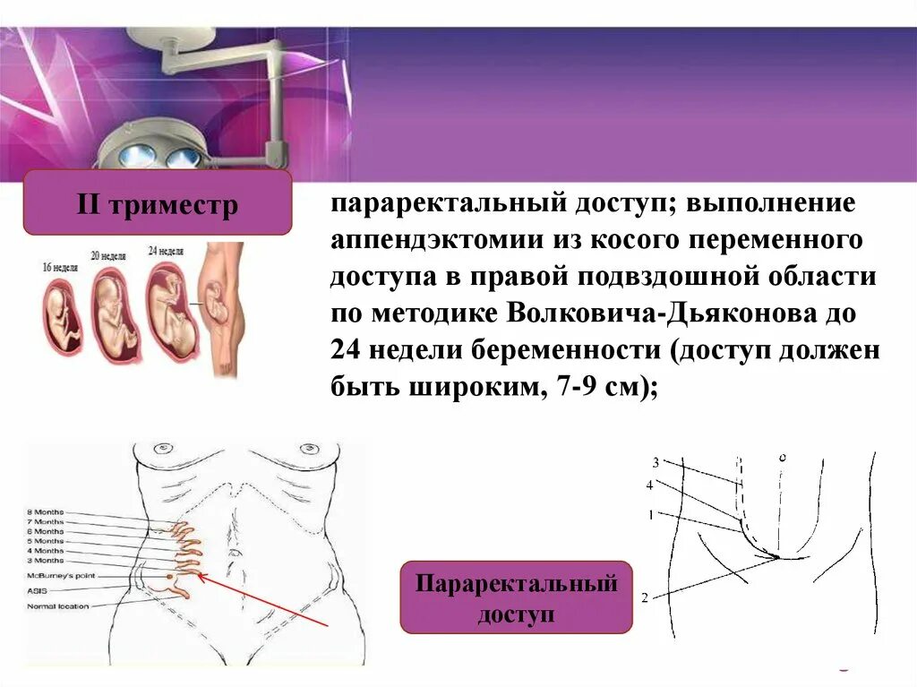 Аппендицит во 2 триместре беременности. Аппендицит у беременных в 3 триместре. Доступы при аппендэктомии. Параректальный доступ при аппендэктомии. Острый аппендицит у беременных