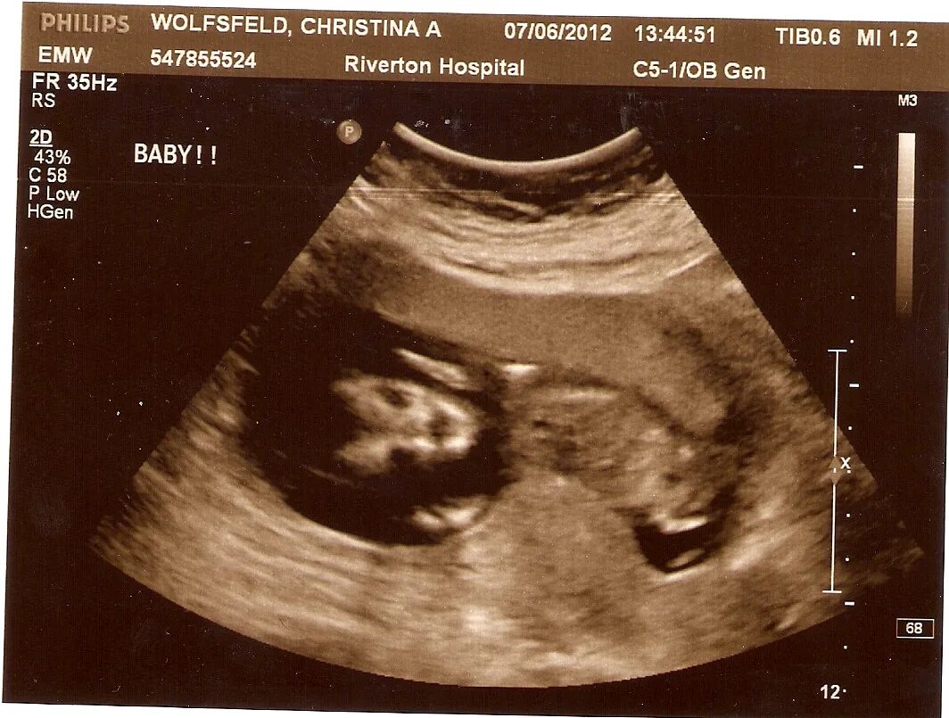 Задание 14 недели. УЗИ 14 недель беременности. 14 Недель беременности фото плода на УЗИ пол ребенка. Плод ребёнка в 8 недель беременности фото УЗИ.