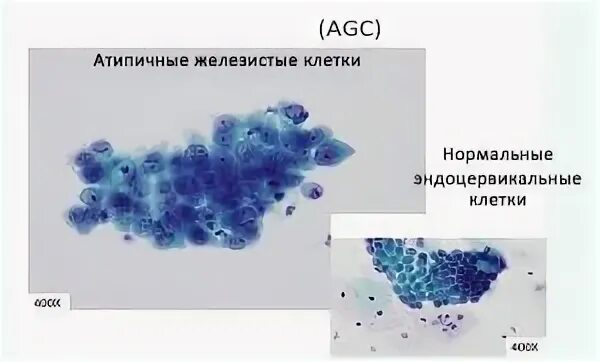 Цитологическая картина коллоидного узла. Nilm цитология что это. Плоскоклеточная метаплазия железистого эпителия без атипии клеток. Метаплазированные клетки. Nilm цитология что это такое