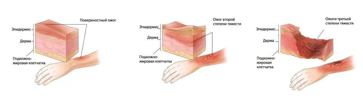 Солнечный ожог 2 и 3 степени. Солнечные ожоги 1 и 2 степени. Солнечные ожоги по степени тяжести.