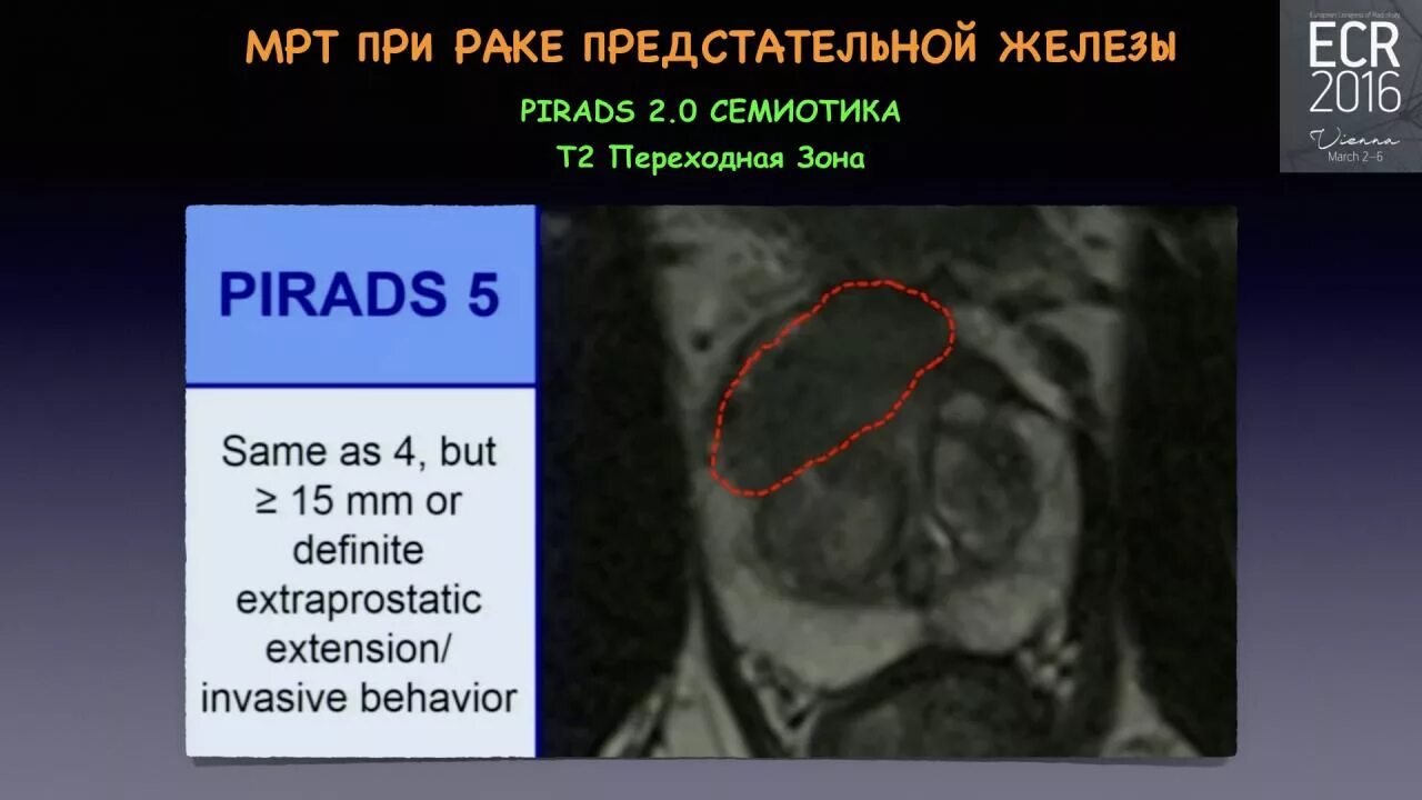 Pi rads 4. Классификация pi-rads мрт простаты. зоны предстательной железы pirads. pi rads транзиторная зона.