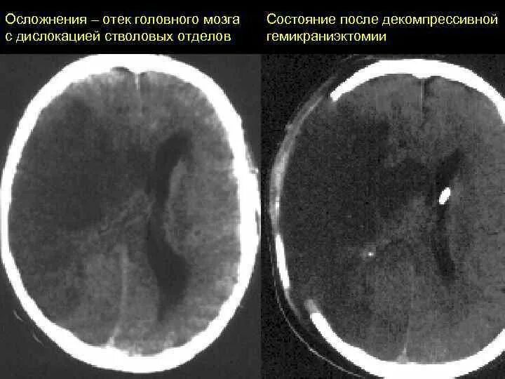 Острый отек мозга. Цитотоксический отек головного мозга кт. Вазогенный отек мозга на кт. Токсическое поражение головного мозга кт. Цитотоксический отек головного мозга на мрт.