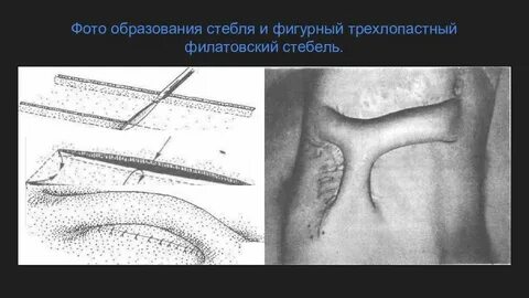Стебель филатовой