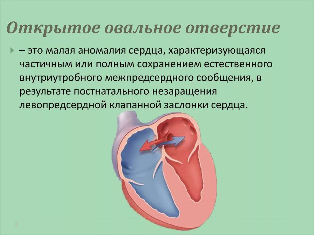 Где находится овальное окно. Функционирующее открытое овальное окно у новорожденных. Овальная ямка межпредсердной перегородки. Открытое овальное отверстие у новорожденного. Открытое овальное окошко у новорожденного.