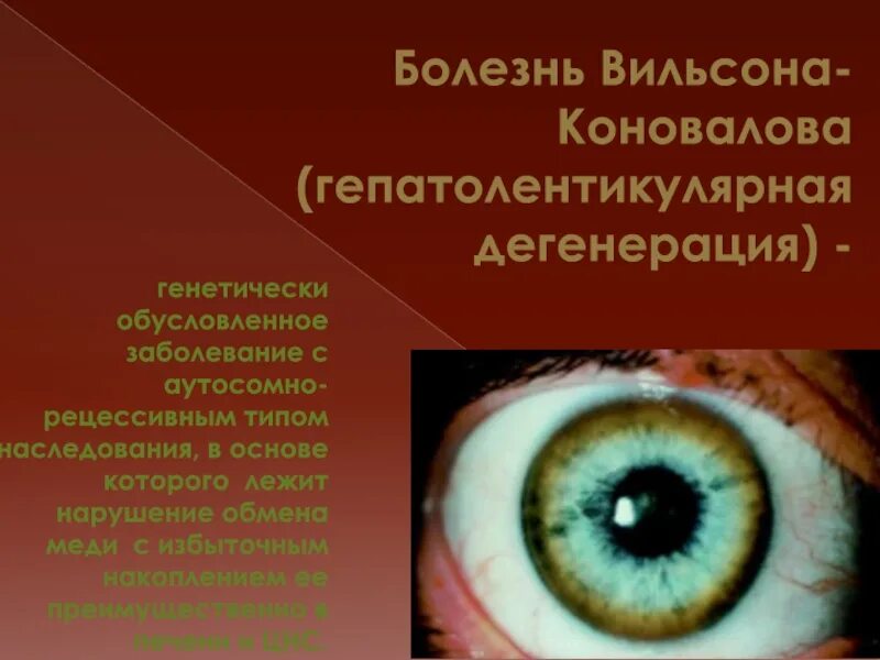 Синдром вильсона коновалова что это такое простыми. Синдром Вильсона Коновалова. Дрожательно ригидная форма болезни Вильсона-Коновалова. Вильсона Коновалова церулоплазмин. Болезнь Вильсона — Вестфаля — Коновалова.