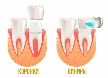 Разница между винирами и коронками