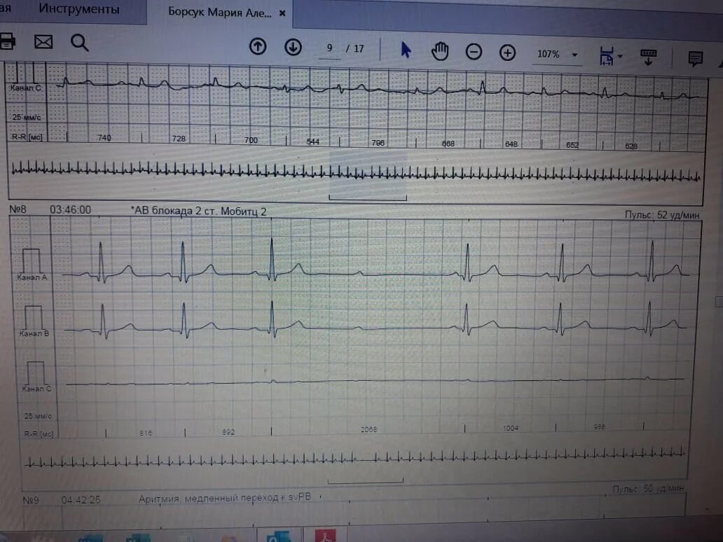 Синусовая блокада 2 степени экг. Холтер ав блокада 2:1. Атриовентрикулярная блокада мобитц 1 на экг. Ав блокада 2 ст 1 типа. Синоатриальная блокада 2 степени 2 типа на экг.