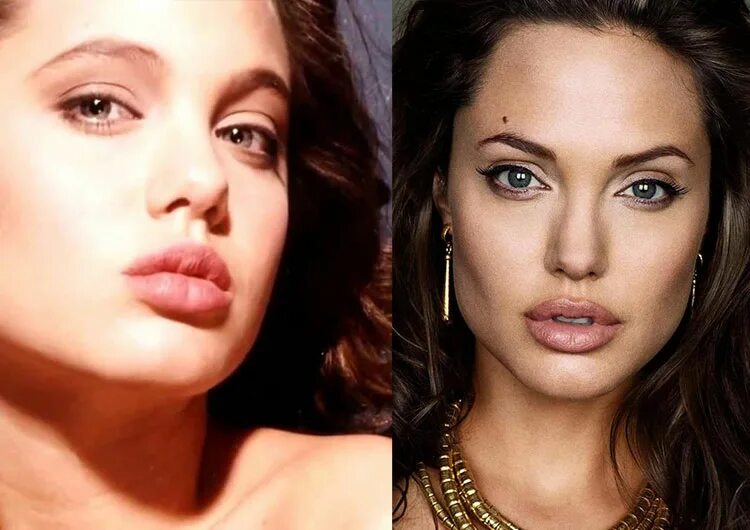 Джоли до пластики. Анджелина Джоли ментопластика. Анджелина Джоли до и после пластики. Губы Анджелины Джоли до и после. Анджелина джоли до пластики