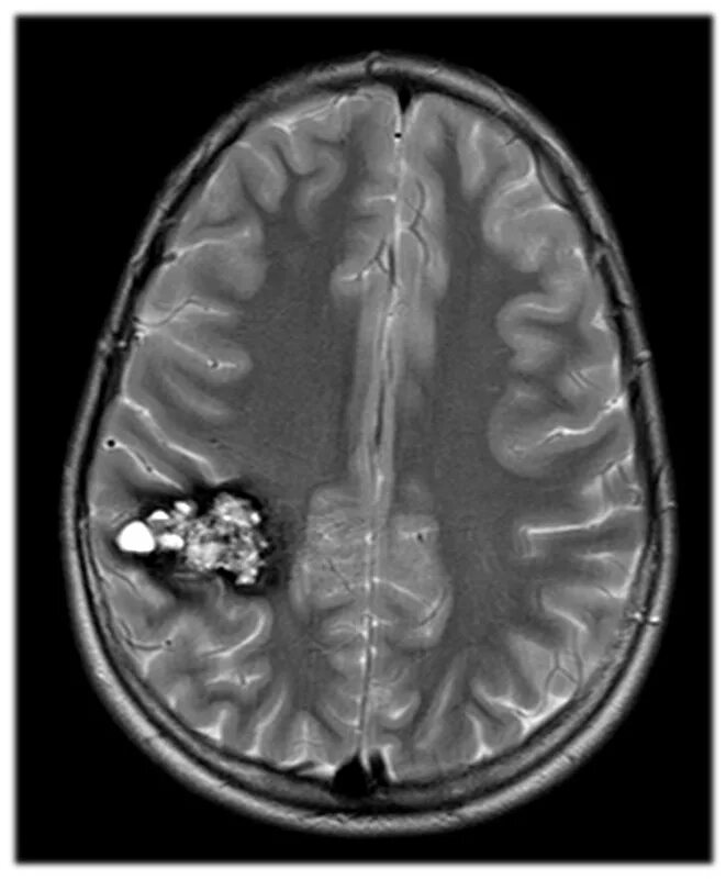 Кавернома головного мозга. Кавернозная кавернома. Кавернозная ангиома головного. Ангиома правой лобной доли