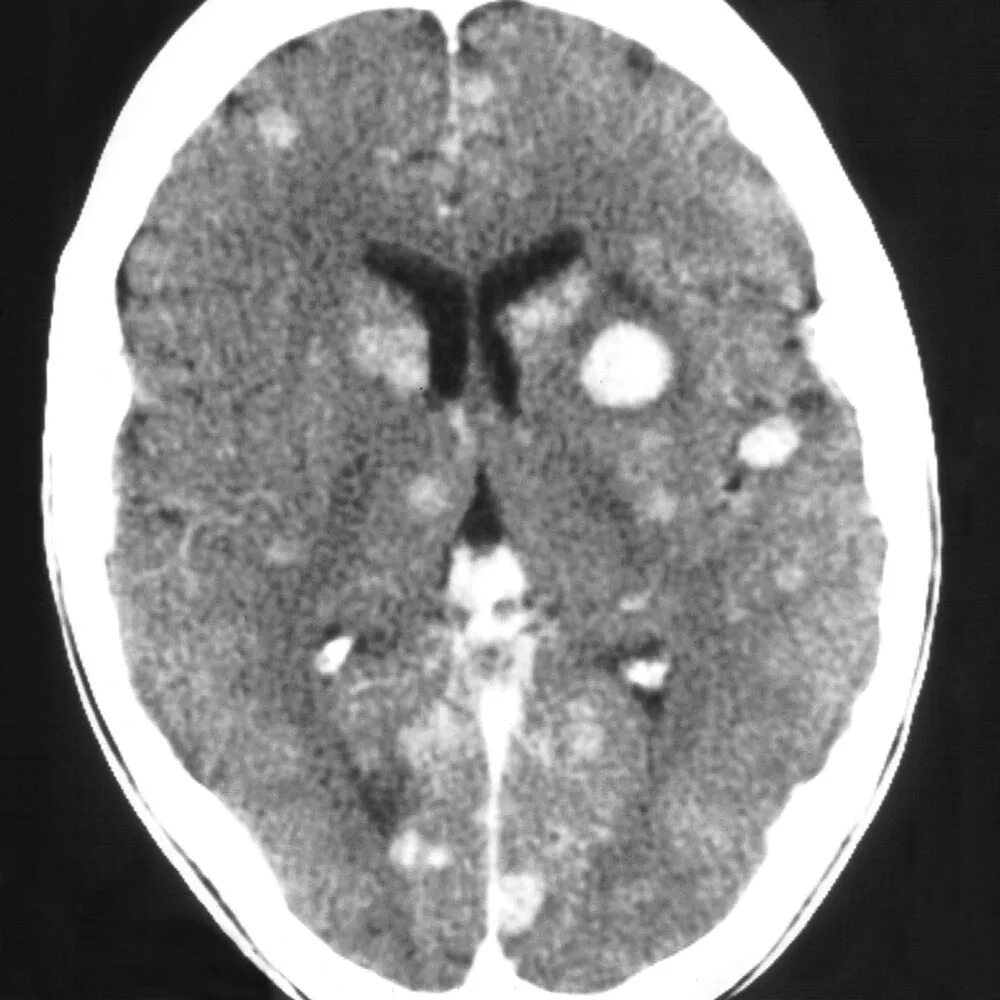 Меланома метастазы в мозг. Меланома на кт головного мозга. Синдром метастаз в мозге.