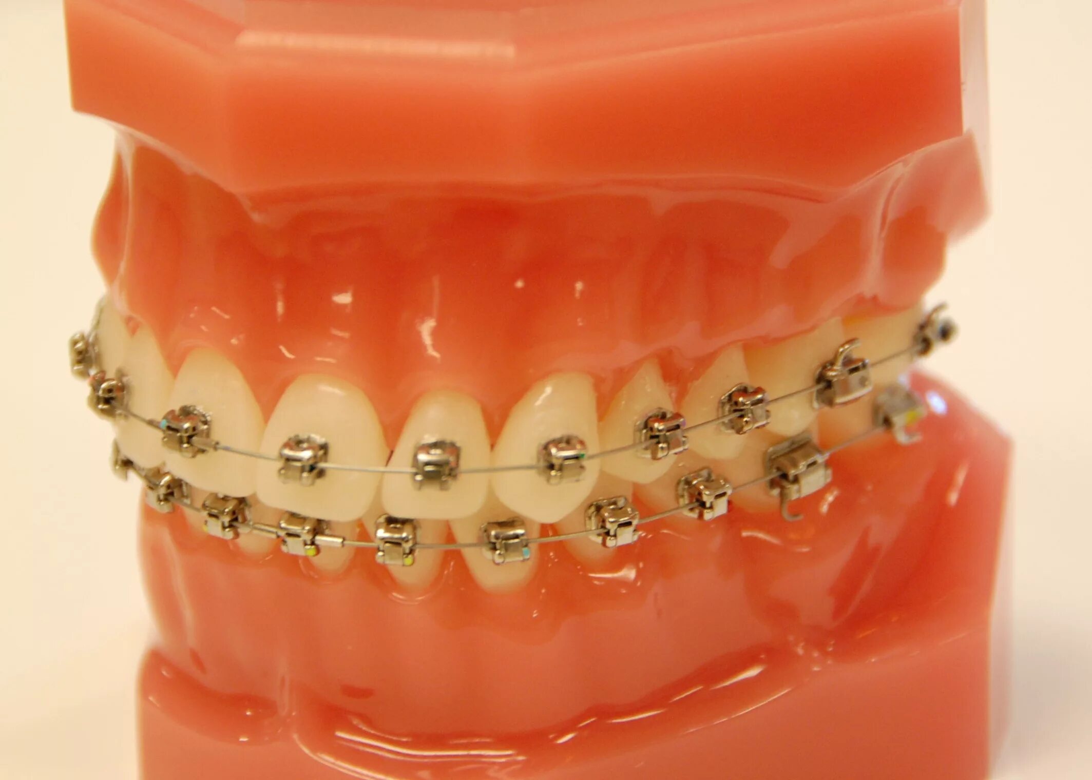 damon clear braces Damon clear braces, Clear braces, Damon braces