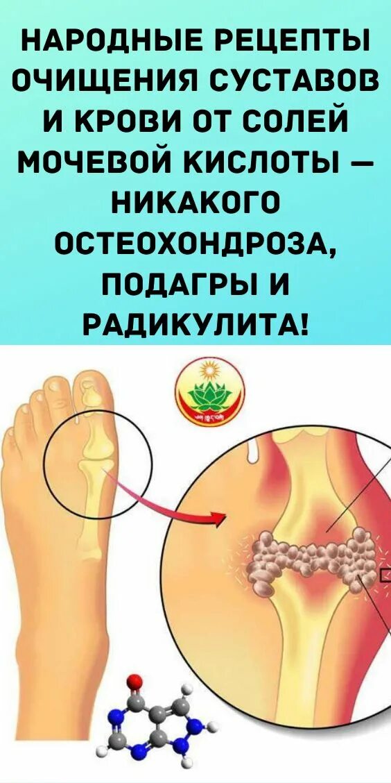Соли в суставах рук. Отложения солей мочевой кислоты в коленном суставе. отложение солей в суставах. отложение солей мочевой кислоты в суставах. отложение солей соли в суставах.