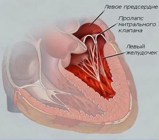 Наличие хорды у человека. Дополнительная хорда митрального клапана. Пролапс митрального клапана. Пролапс митрального клапана хорда. Передняя створка митрального клапана.