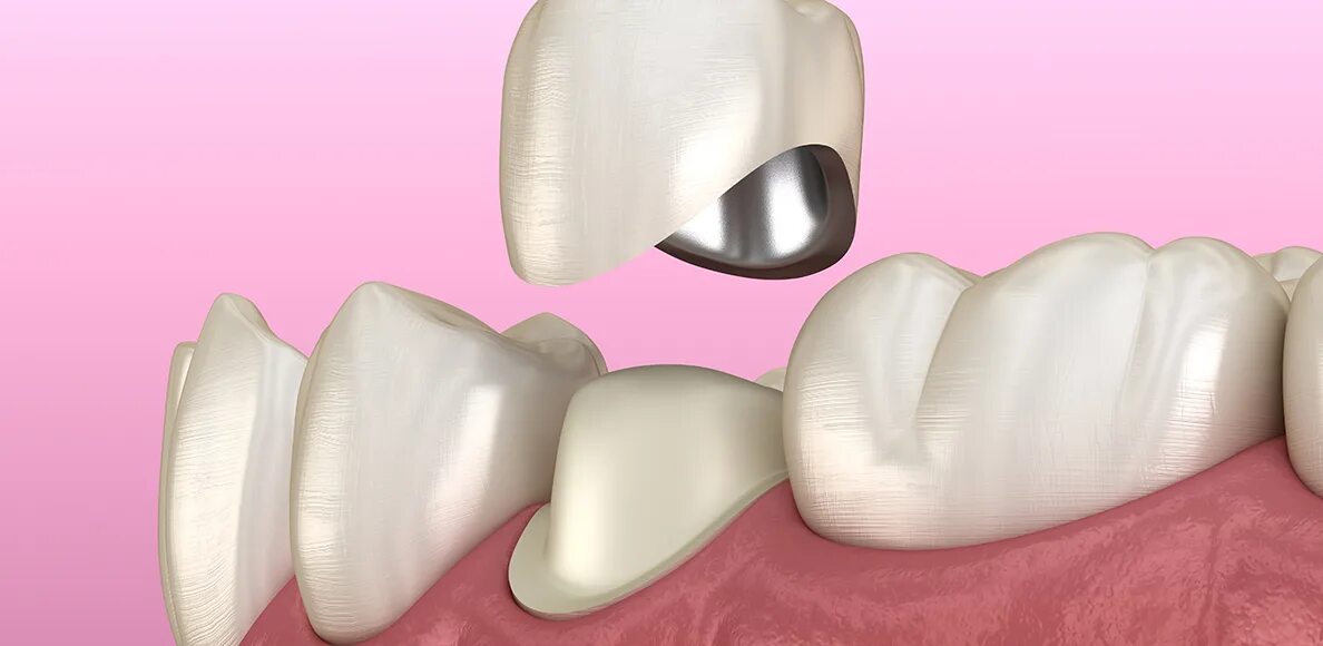 Установка зубы жевательные. Имплант 5 зуба верхней челюсти. Имплант жевательного зуба. Установка зубы жевательные. Несъёмные мостовидные шинирующие протезы.