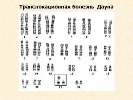 Кариотип транслокации