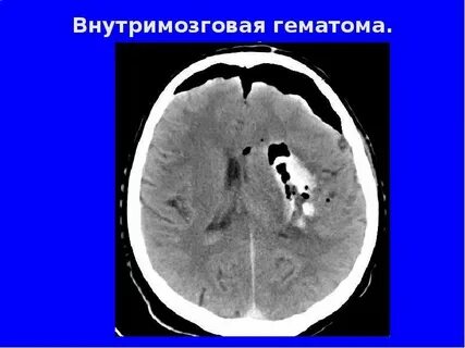 Пневмоцефалия
