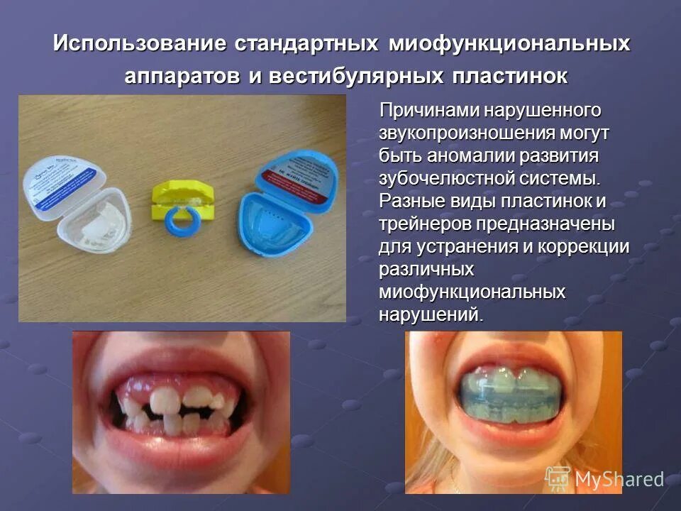 Миофункциональные нарушения в логопедии