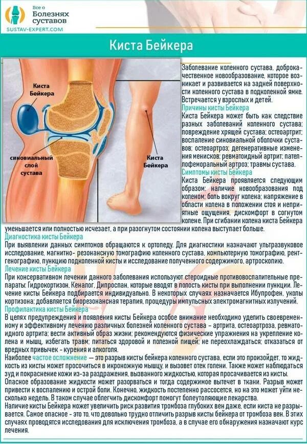 Ревматоидный коленный сустав: киста Бейкера, сгибательные деформации. Бейкера киста Бейкера коленного сустава. Эффективное лечение боли в колене