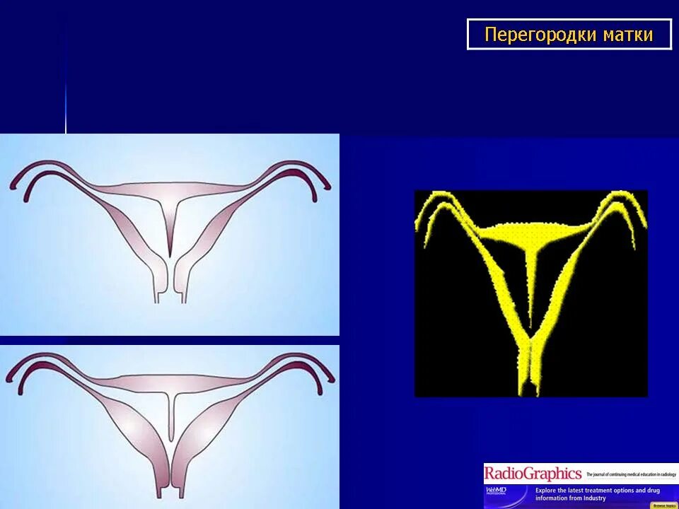 Двурогая матка и перегородка в матке. Двурогая седловидная матка. Неполная двурогая матка. Двурогая матка макропрепарат. Что такое двурогая матка