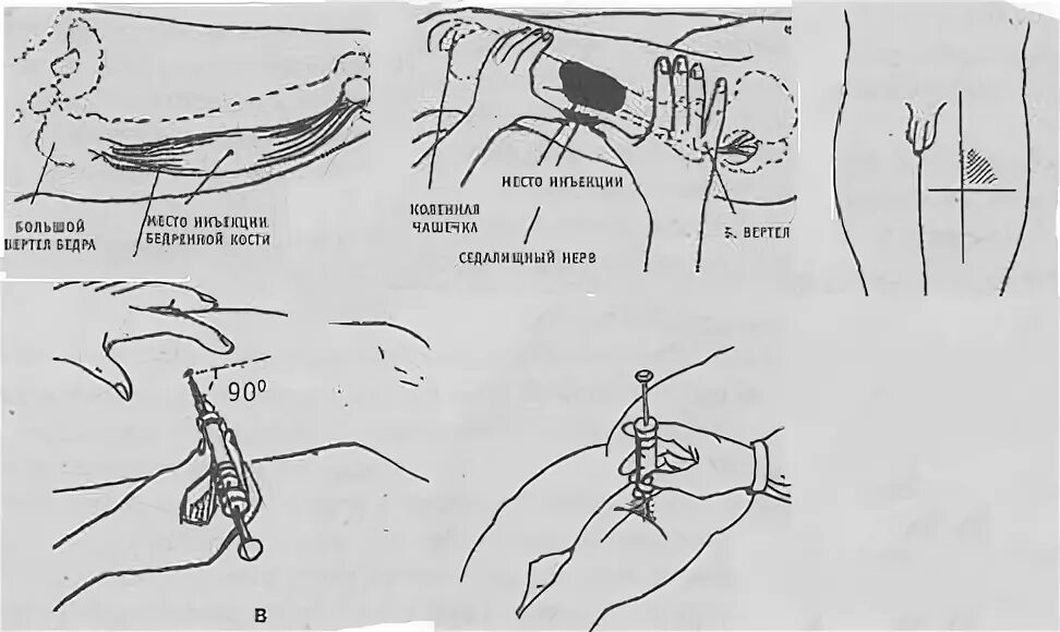 Укол внутримышечно в ногу самому себе видео. Схема внутримышечной инъекции в бедро. Постановка внутримышечной инъекции в бедро алгоритм. Укол в бедро внутримышечно самому схема. Внутримышечная инъекция в бедро алгоритм.