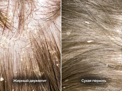 Сухие выпадения