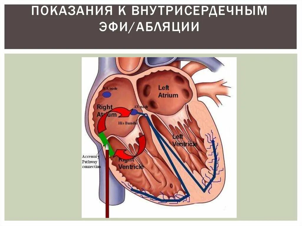 Рча предсердий. Радиочастотная абляция сердца. Катетерная абляция сердца что это такое. Внутрисердечная эхокардиография. Внутрисердечная катетерная абляция.