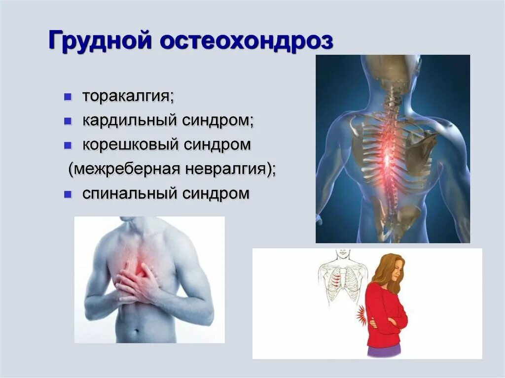 Грудной остеохондроз межреберная