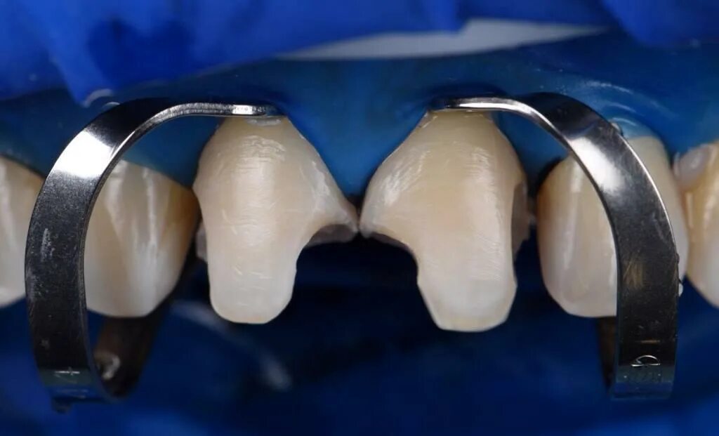 Материалы для прямых реставраций. Материалы для прямых реставраций. Эстетических непрямых реставрация. Художественная реставрация передних зубов. Стоматологические пломб.