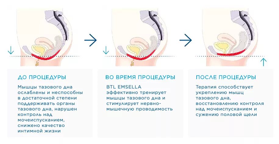 При половом акте мочеиспускания у женщин. BTL Emsella аппарат. BTL Emsella кресло. Аппарат Emsella для укрепления мышц тазового дна. Кресло для магнитотерапии тазового дна.