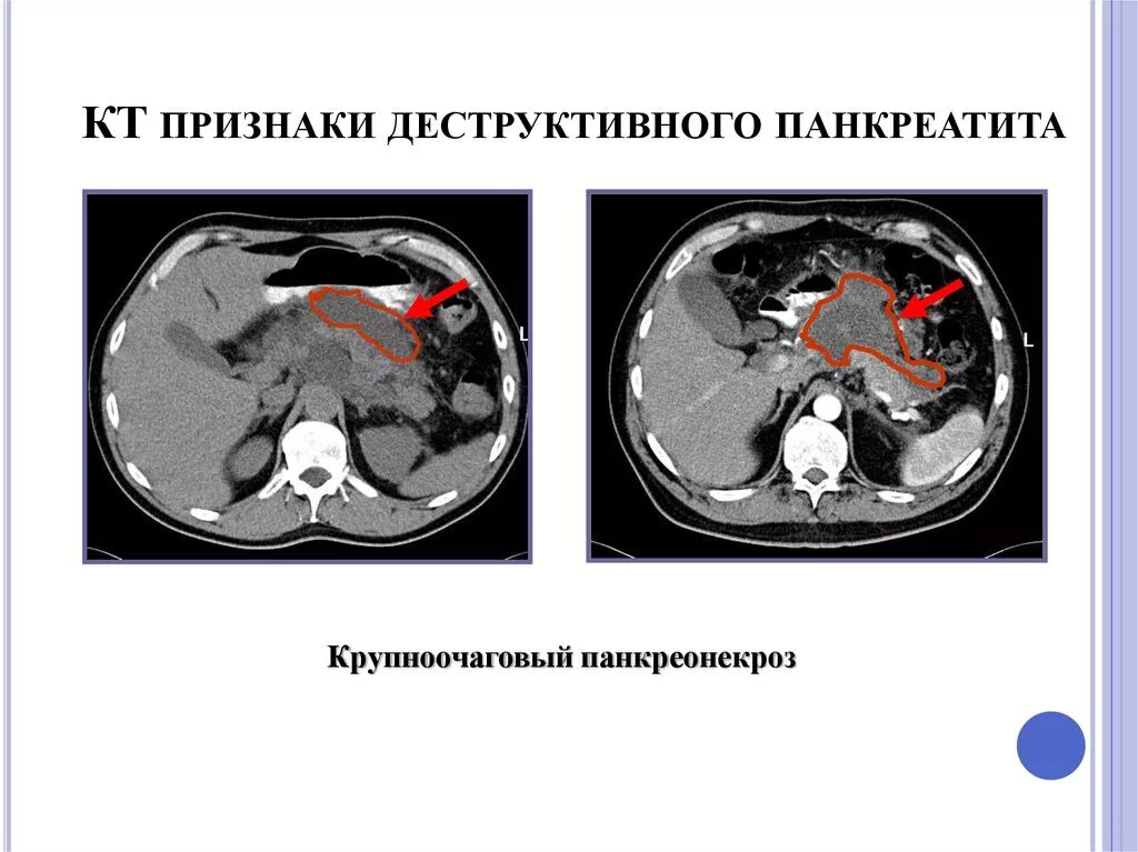 Псевдотуморозный панкреатит на кт. Диагностика заболеваний поджелудочной железы. Боль поджелудочной железы. Панкреонекроз поджелудочной. Опухоли поджелудочной железы классификация.