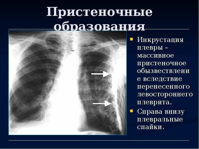 Шварты в легких это. Обызвествление плевры рентген. Левосторонний плеврит рентген. Плевральная шварта рентген.