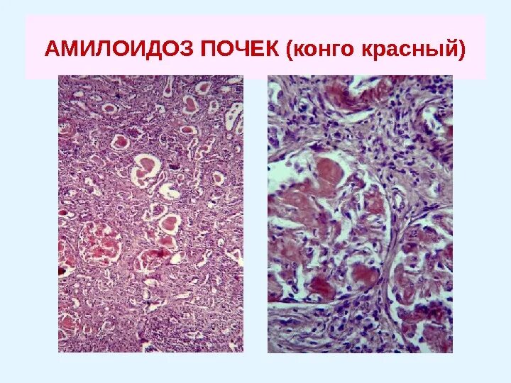 Амилоидоз препарат. Микропрепарат амилоидоз почек окраска конго-красный. амилоидоз почек окраска конго красный. амилоидоз почки гистопрепарат. амилоидоз почек гистология.