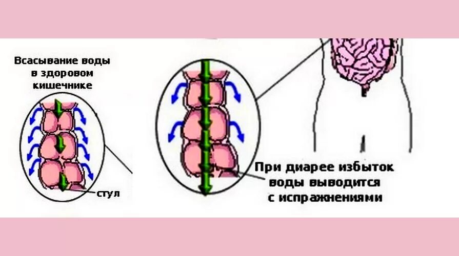 Понос воняет. Диарея с запахом тухлых яиц. Жидкий стул с запахом тухлых яиц. Всасывание воды в кишечнике.