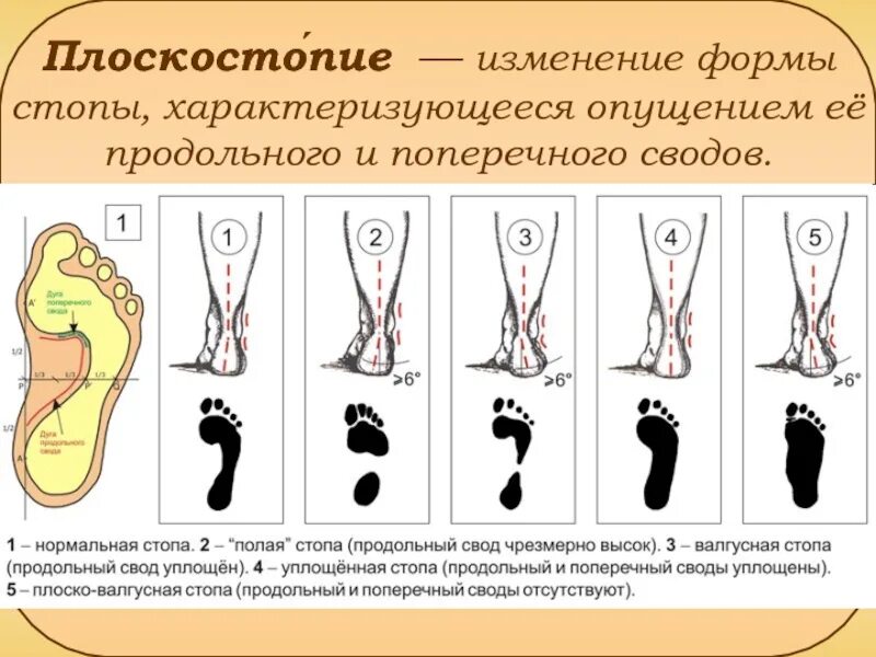 Правильная форма члена. Поперечное плоскостопие и вальгусная деформация. Поперечное плоскостопие отпечаток стопы. Нормальный свод стопы и плоскостопие. Плоскостопие поперечного свода стопы.