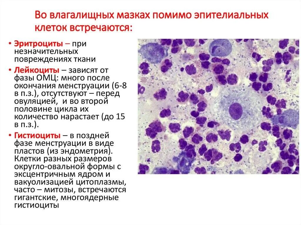 Умеренная местами выраженная лейкоцитарная инфильтрация