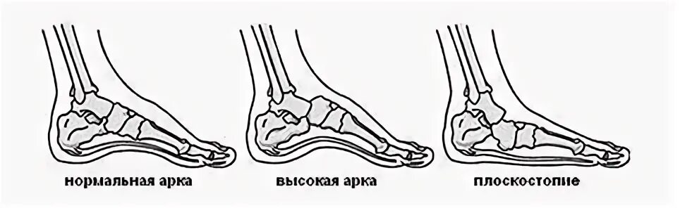 Flat footed