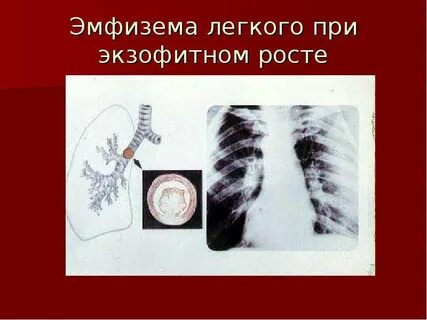 Эмфизема тканей