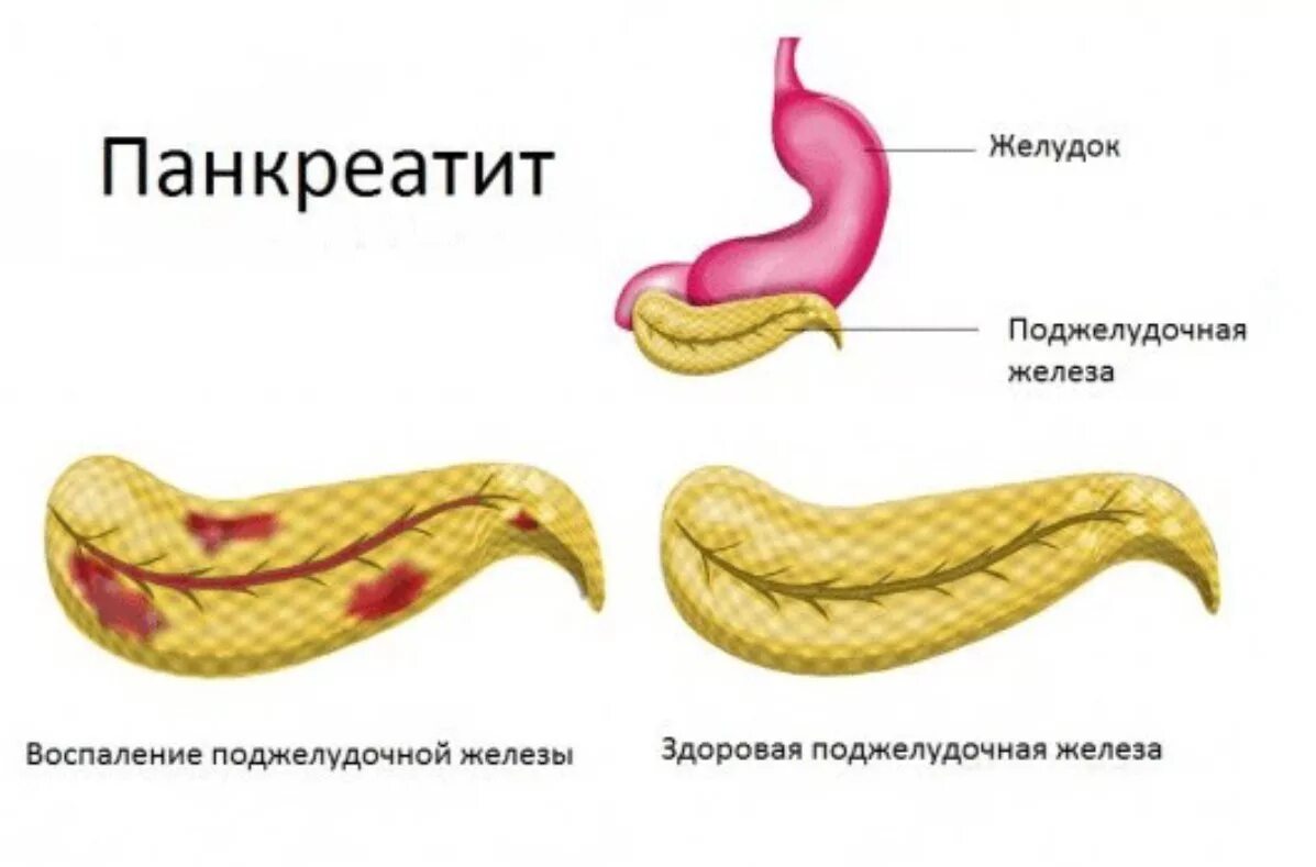 Панкреатин поджелудочная железа. Острый панкреатит поджелудочной железы. Острый и хронический панкреатит. Хроническое воспаление поджелудочной железы. Панкреатит ноги