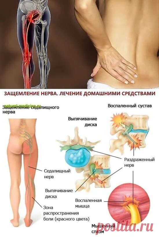 Боли в пояснице защемление нерва лечение. Защемление седалищного нерва. Защемление нерва лекарства. Защемление поясничного нерва. Защемление нерва симптомы.