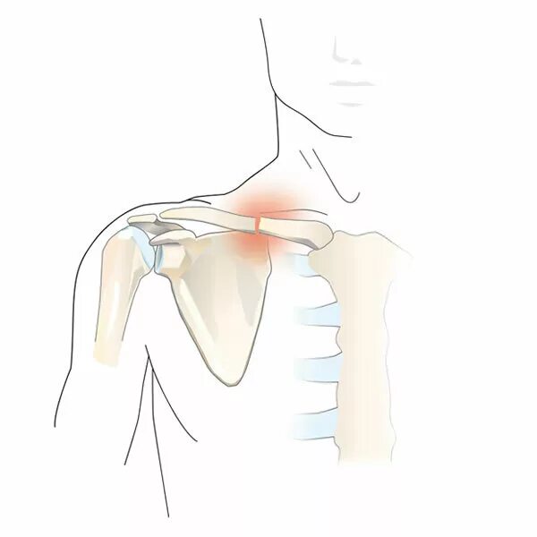 Трещина болит. Закрытый оскольчатый перелом ключицы. Оскольчатый перелом ключицы. Перелом акромиона ключицы. Остеомиелит грудино-ключичного сочленения.