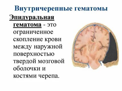 Виды гематом