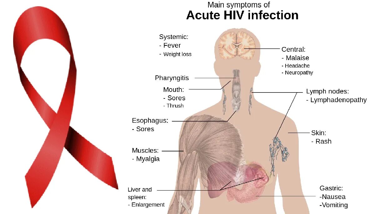 Вич симптомы первые ранние признаки. Главные симптомы острой ВИЧ инфекции.