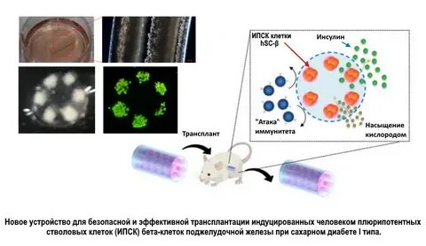 Диабет бета клетки