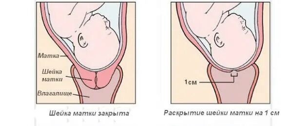 Почему раскрывается матка. Первый период родов (период раскрытия). Шейка матки перед родами.