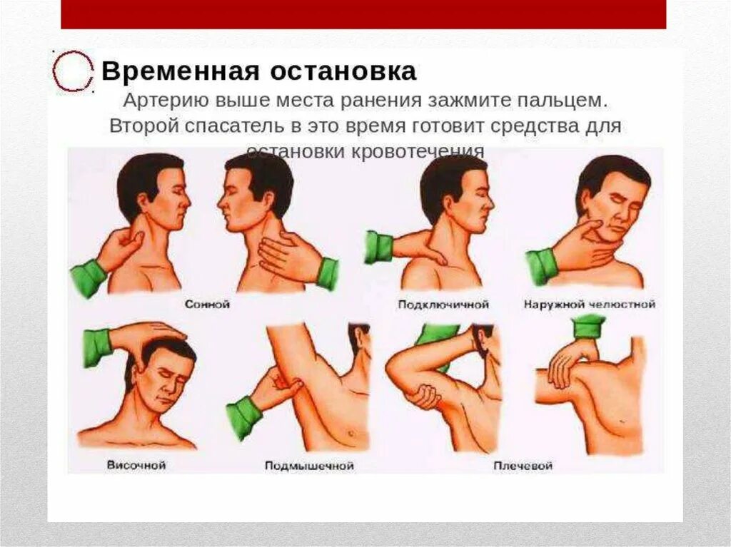 Способ временного гемостаза при ранении сонной артерии. Остановка кровотечения из артерии. Остановка кровотечени. Методы остановки кровотечений из артерий. Чем можно остановить кровотечение