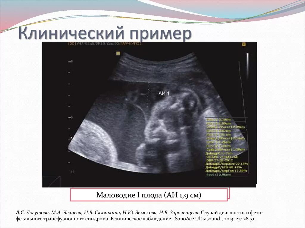 Маловодии 38 неделя. Маловодие на УЗИ. УЗИ при маловодии. Маловодие при беременности на УЗИ. Критерии маловодия на УЗИ.